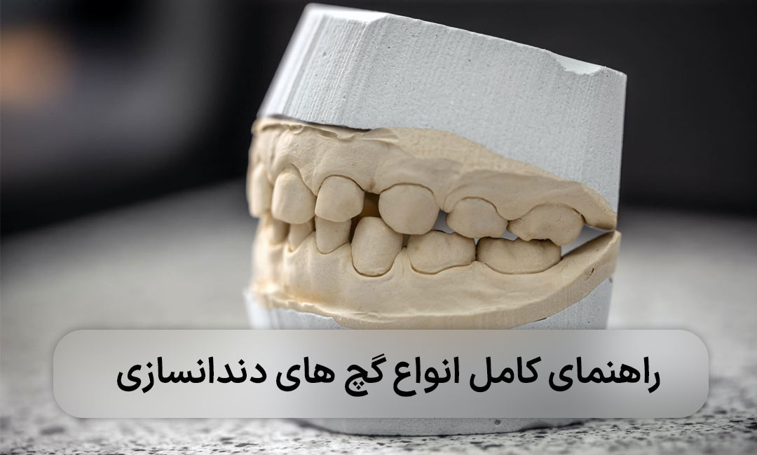 انواع گچ دندانسازی