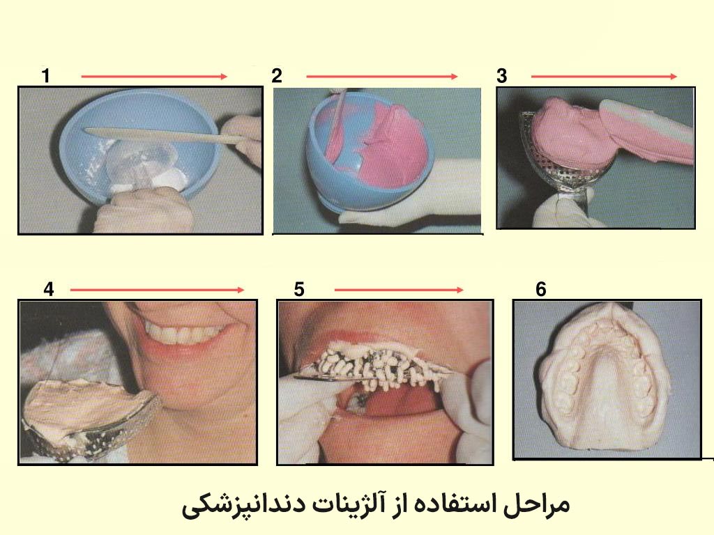 مراحل قالب‌گیری با آلژینات دندانپزشکی