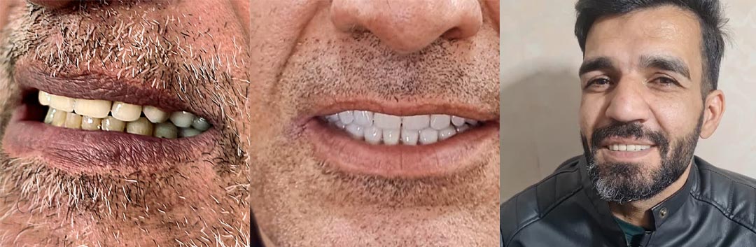 نمونه کار دندانسازی کریمی محلات